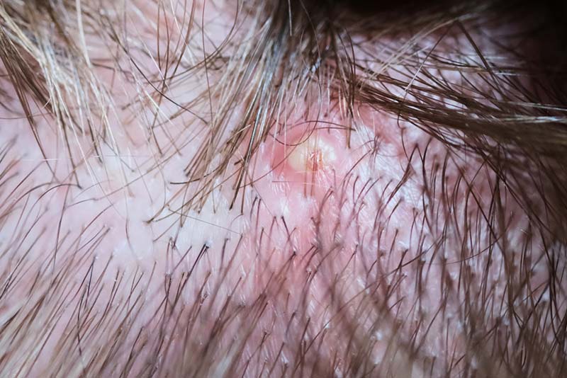 bị viêm chân tóc
