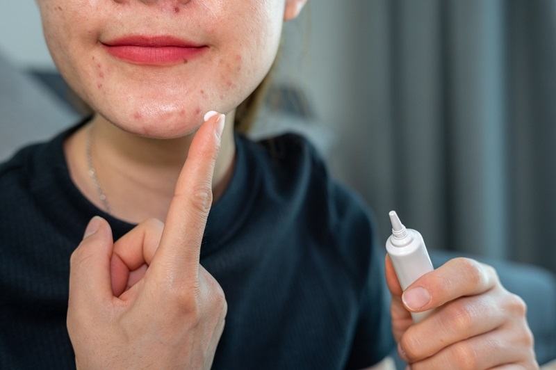 Cách chọn thuốc trị sẹo phù hợp