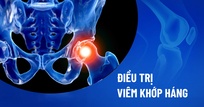 Điều trị viêm khớp háng