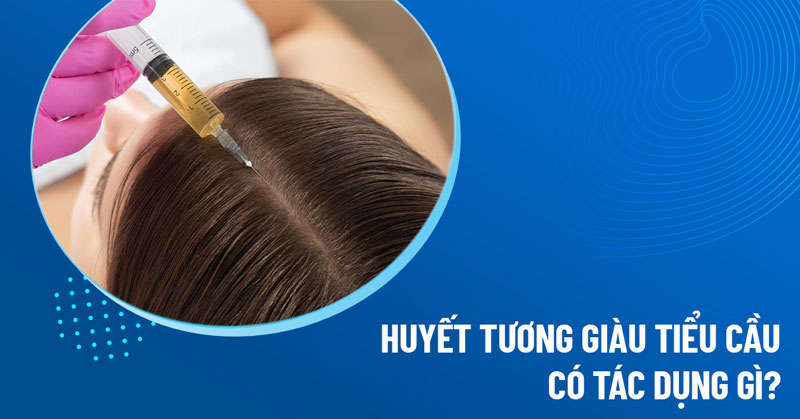 huyết tương giàu tiểu cầu