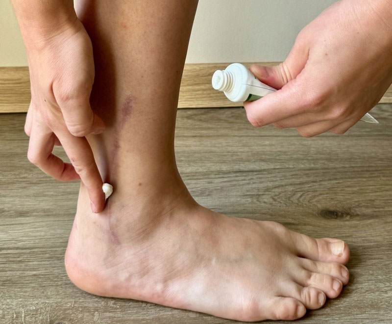 Khi nào nên dùng thuốc trị sẹo