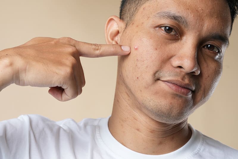 Mụn trứng cá có thể là dấu hiệu thiếu kẽm ở nam giới