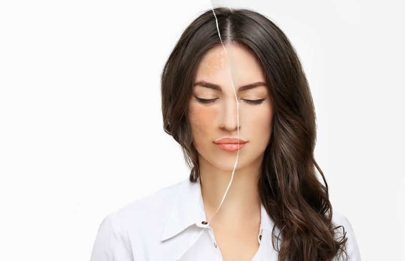 Nguyên nhân gây ra tình trạng nám da sau sinh là do rối loạn nội tiết tố estrogen và progesterone bên trong cơ thể.