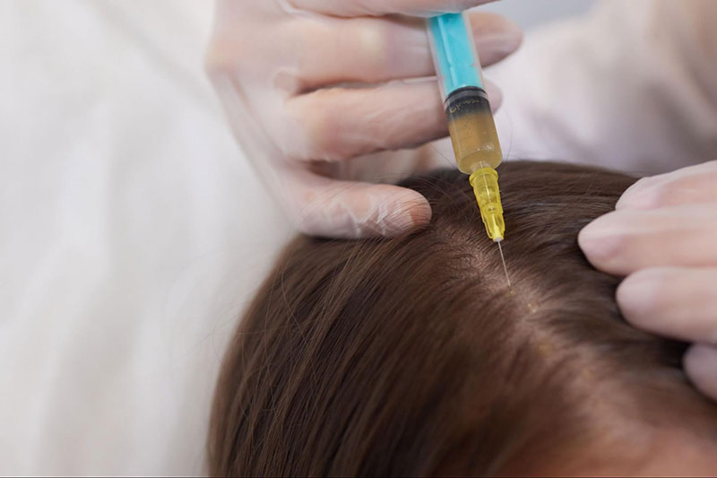 prp có tác dụng giảm rụng tóc