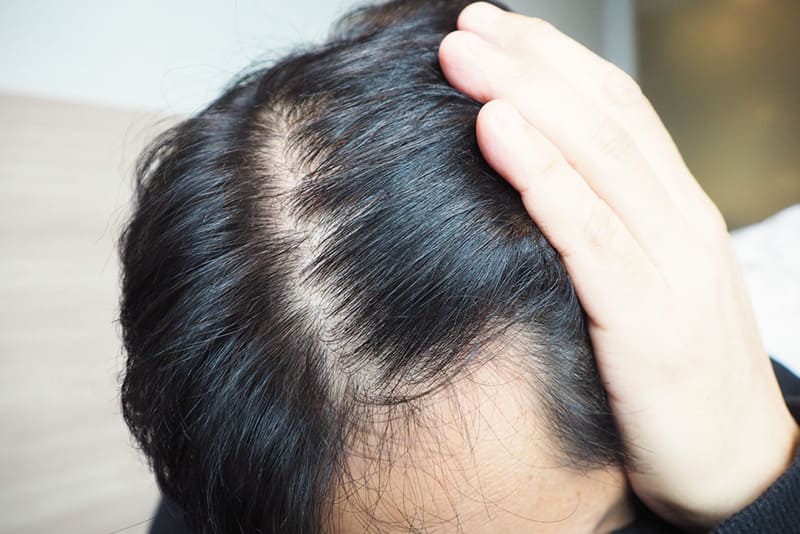 Rụng tóc có thể là triệu chứng thiếu kẽm ở nam giới