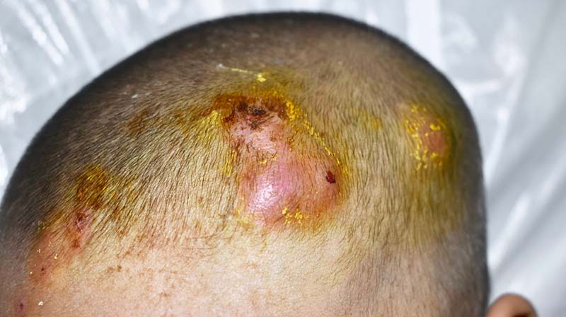 rụng tóc từng mảng do viêm chân tóc