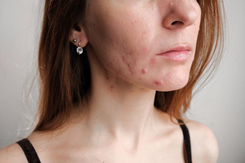 Sẹo rỗ lâu năm do mụn trứng cá, thủy đậu