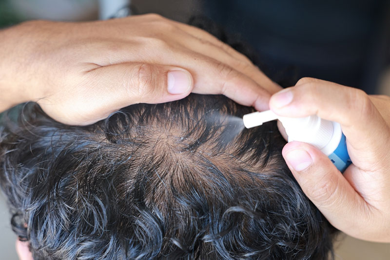 Sử dụng thuốc xịt vào vị trí vùng da đầu cần điều trị.