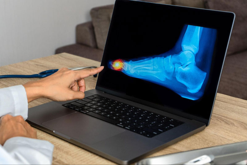 Chẩn đoán viêm khớp ngón chân bằng x-quang