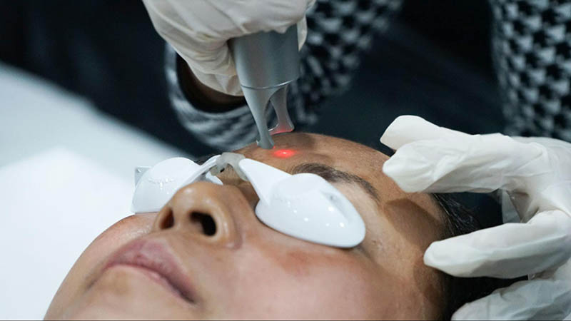 cơ chế laser điều trị nám da
