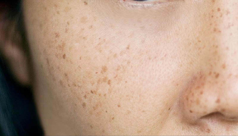 dấu hiệu nhận biết tàn nhang