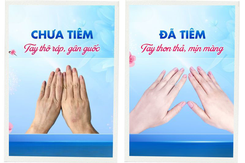 Điều trị lão hóa da bàn tay tại Tâm Anh