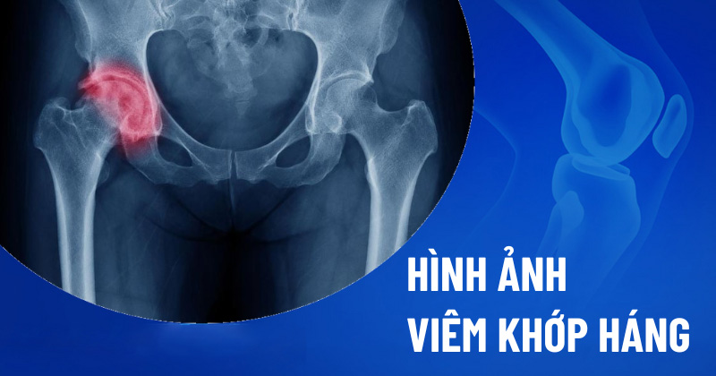 Hình ảnh viêm khớp háng
