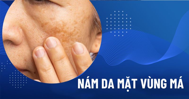 nám da mặt vùng má