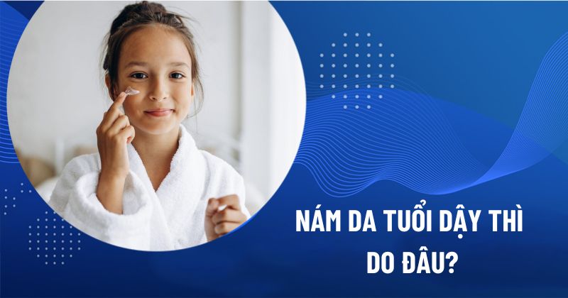nám da tuổi dậy thì do đâu