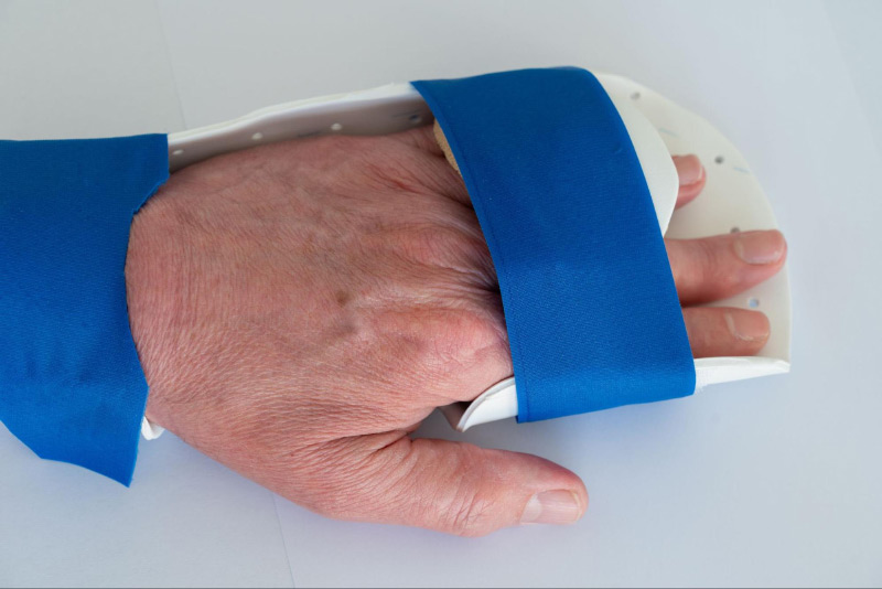 Nẹp bàn tay giúp cải thiện bàn tay gió thổi