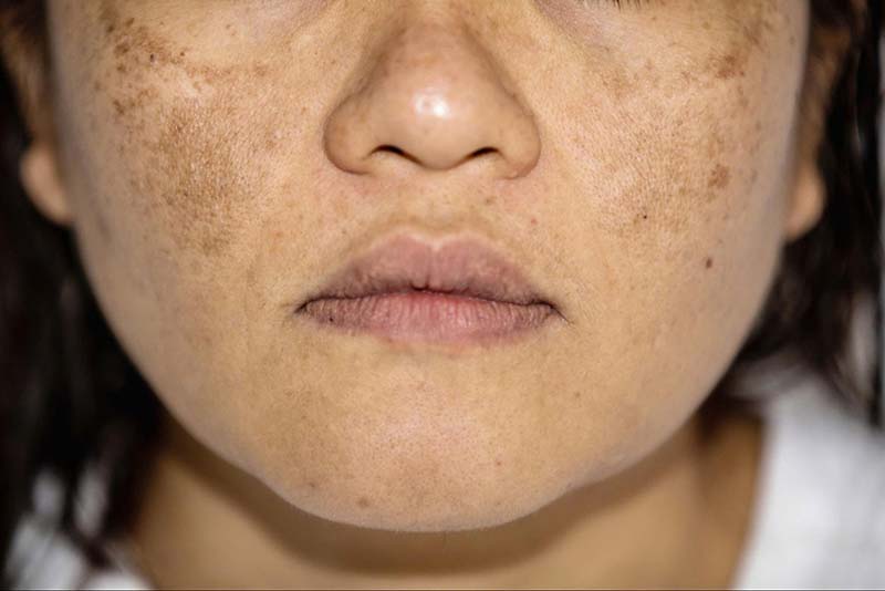 nhận biết da nám