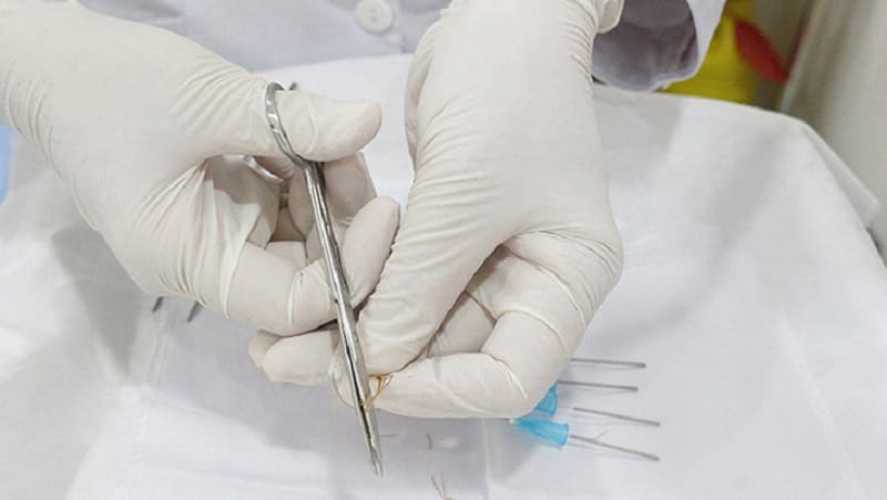 Phương pháp cấy chỉ ít xâm lấn nhưng vẫn tiềm ẩn nguy cơ nhiễm trùng