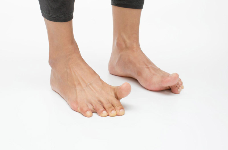 Viêm khớp ngón chân cái gây khó khăn khi vận động