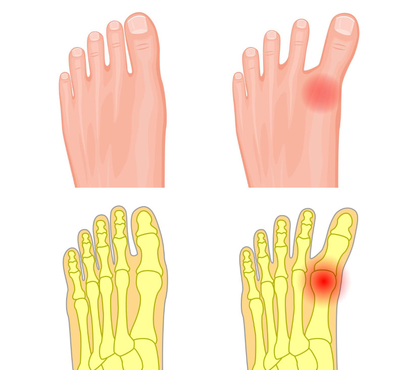 Viêm khớp ngón chân cái là bệnh phổ biến