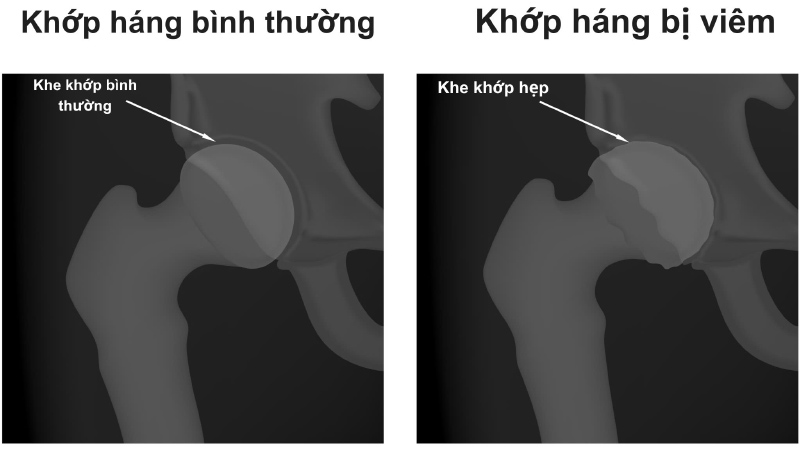X- quang cho thấy khe khớp hẹp nhẹ