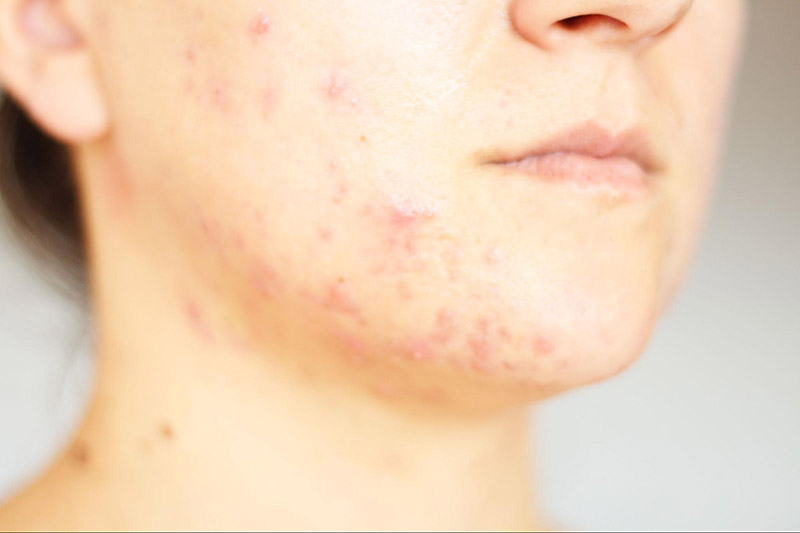 da mụn không nên phi kim điều trị nám