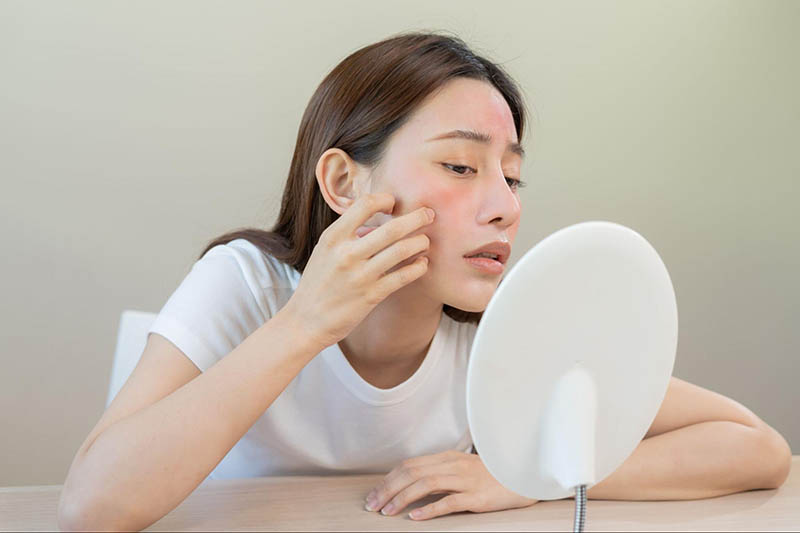 kích ứng khi điều trị nám da