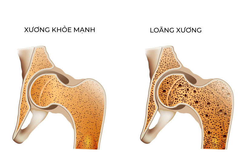 Loãng xương là một biến chứng thường gặp