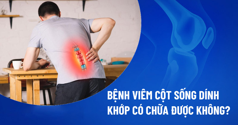 Viêm cột sống dính khớp có chữa được không