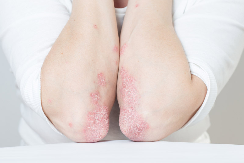 Viêm khớp vảy nến thường gặp ở người trẻ