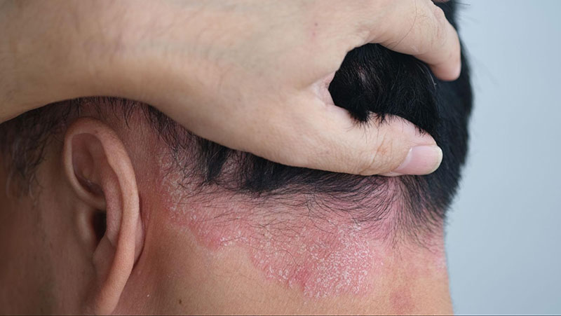 bệnh da đầu gây rụng tóc
