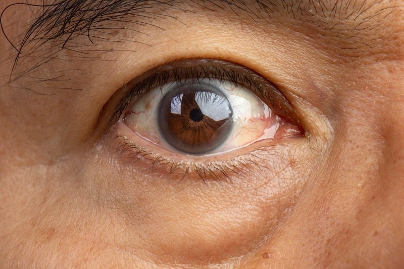 Biến chứng nguy hiểm của những người bị cận thị nặng