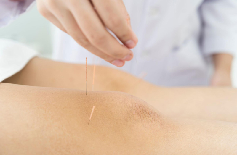 Châm cứu cải thiện đau xương khớp