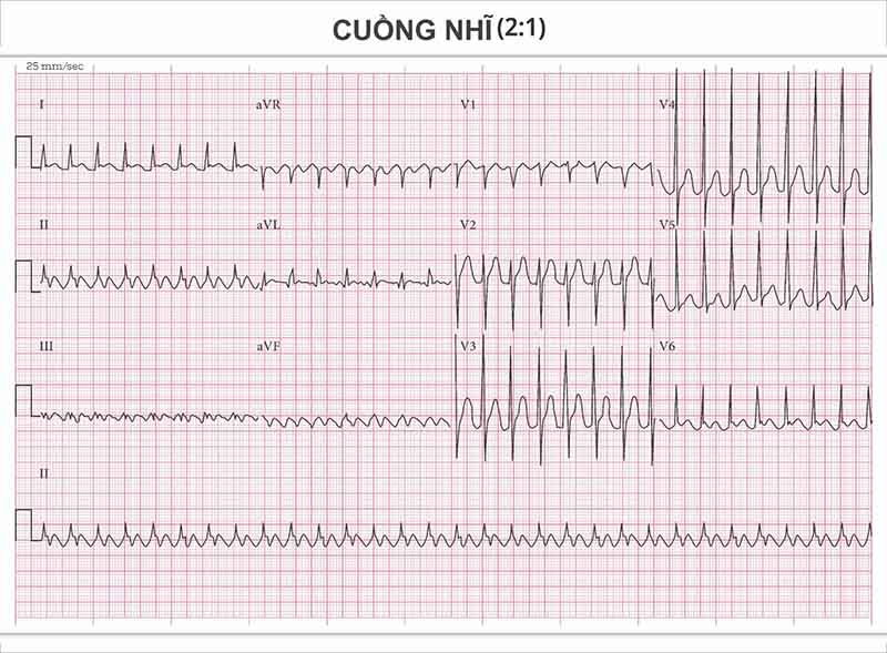 điện tâm đồ bệnh cuồng nhĩ