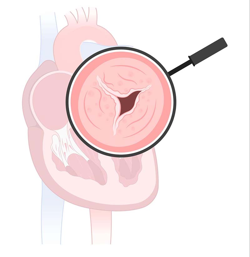 hẹp động mạch chủ của tâm thất trái