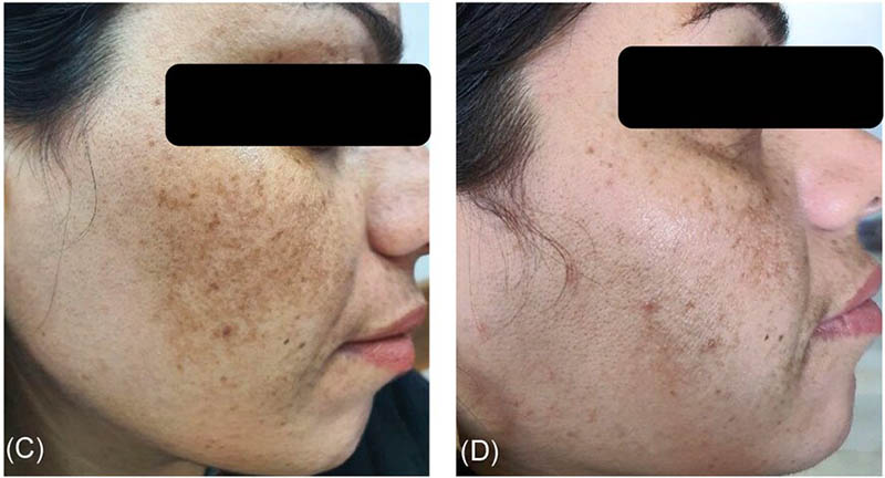 hiệu quả tiêm meso trị nám da mặt