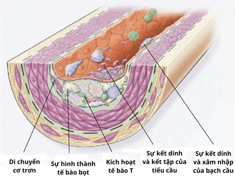 hình ảnh 3 xơ vữa động mạch vành