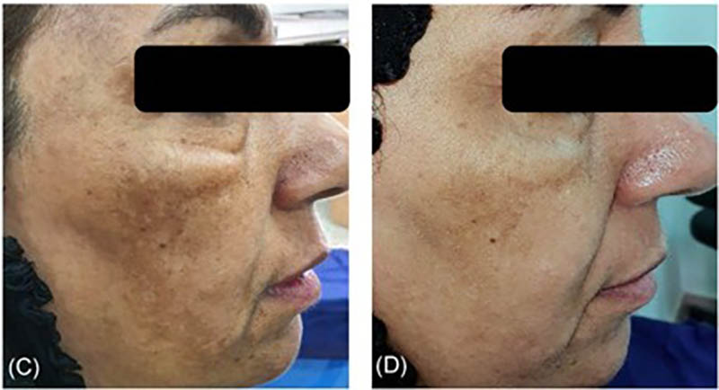hình ảnh trước và sau khi điều trị nám bằng meso