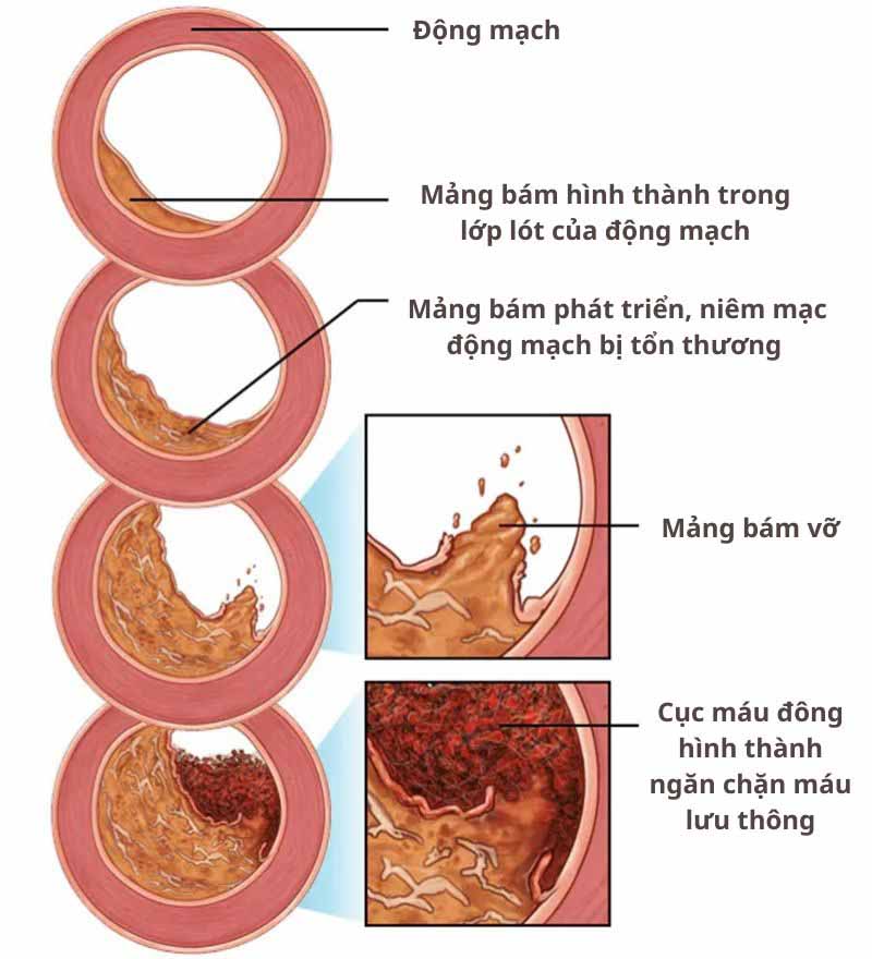 Hình ảnh xơ vữa động mạch