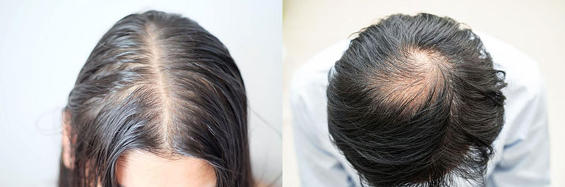 hói đầu ở nữ và nam là khác nhau