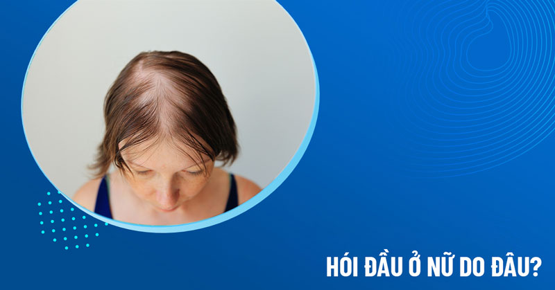 hói đầu ở nữ
