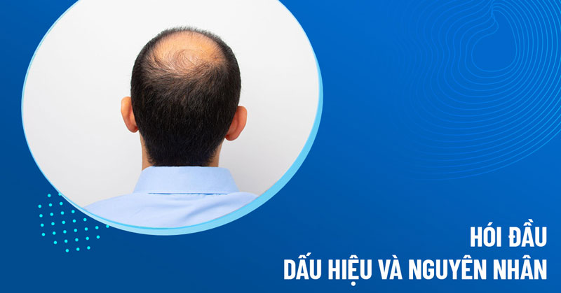 hói đầu