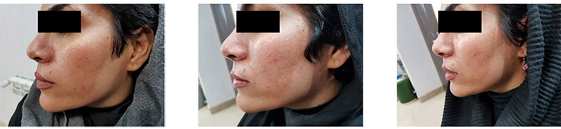 kết quả sau khi tiêm meso trị nám