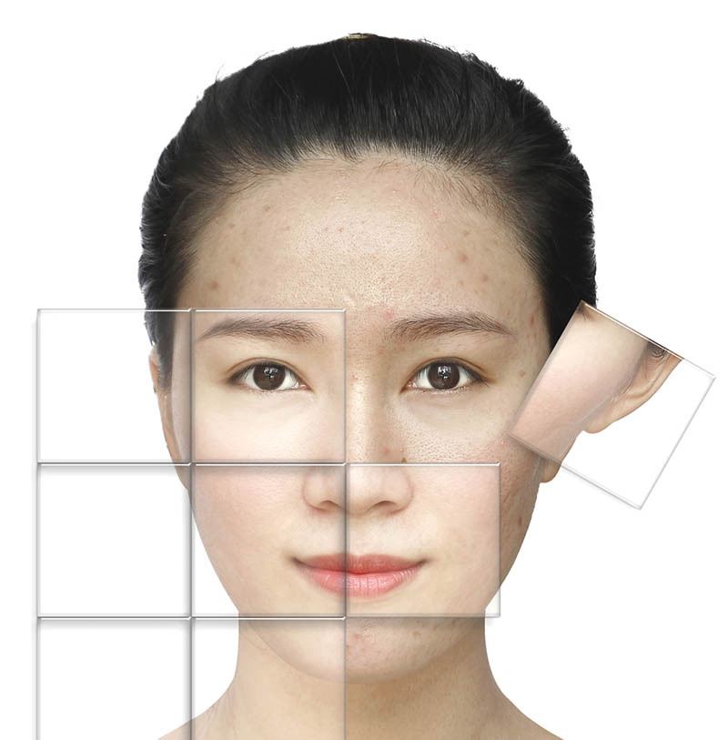 những vị trí da thường bị sạm đen