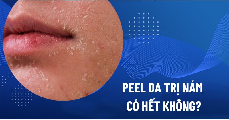 Peel da trị nám có hết không
