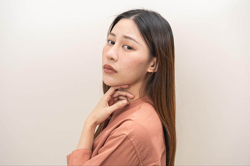 peel da trị nám phù hợp với trường hợp nào