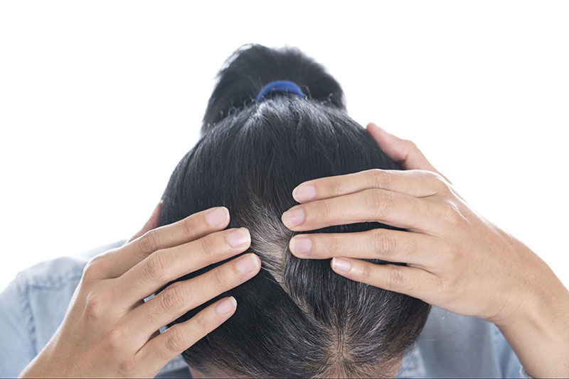 tóc rụng từng mảng ở nữ