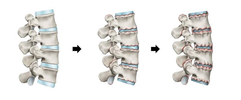 Viêm cột sống dính khớp có di truyền