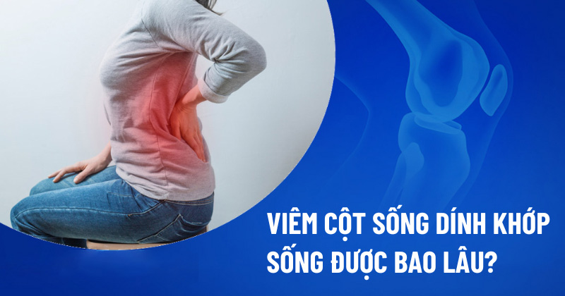 Viêm cột sống dính khớp sống được bao lâu