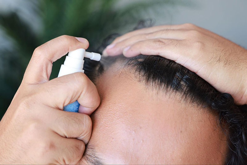 xịt trị hói đầu minoxidil
